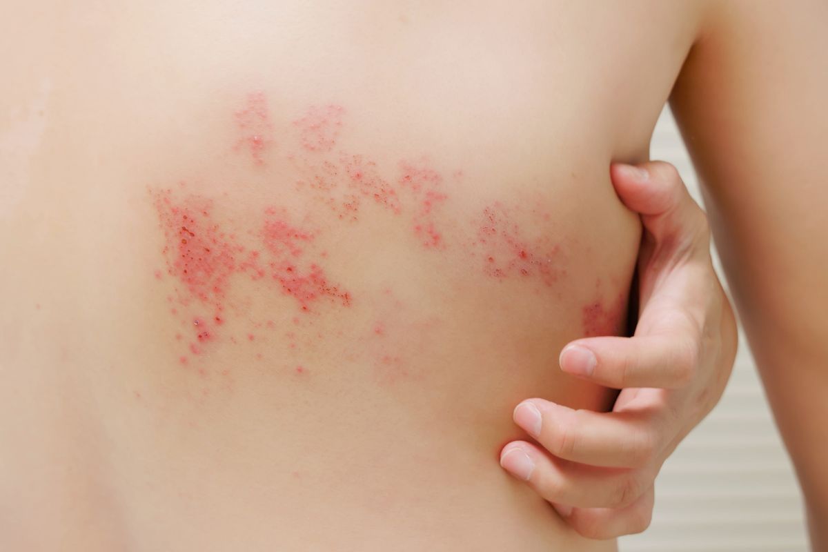 New Study Shows Increased Risk of Shingles After Exposure to COVID-19